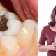 دلیل حساسیت دندان بعد از پرکردن و ترمیم چیست؟